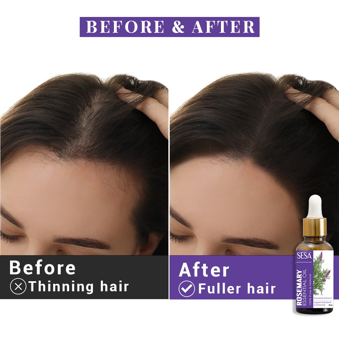 Sesa Ayurvedic Rosemary Essential Oil For Hair Growth - 30 ml