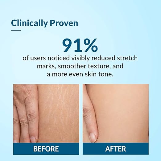 Fixderma Strallium Stretch Mark Cream - 75 gm